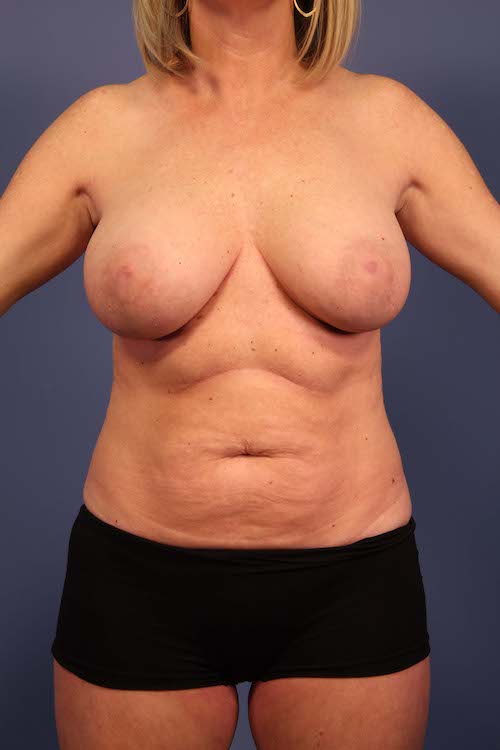 Patient Front View