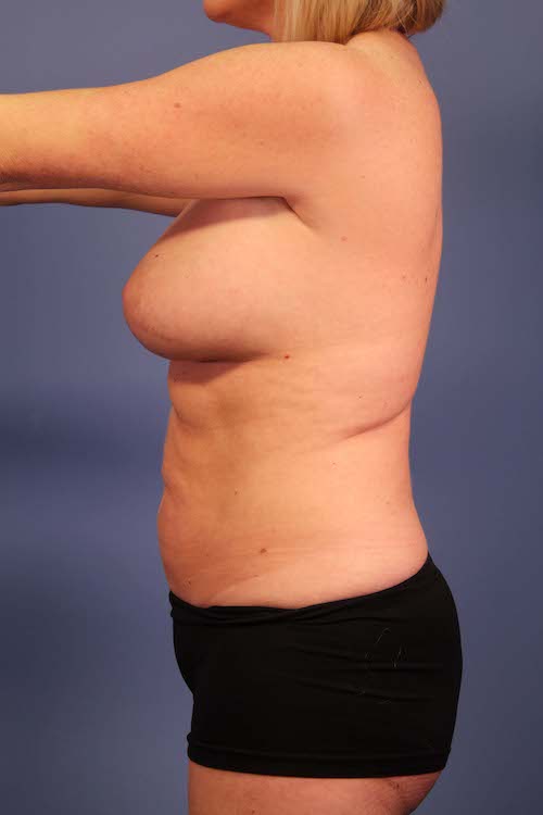 Patient Side View