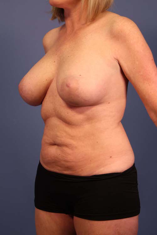 Patient Oblique View